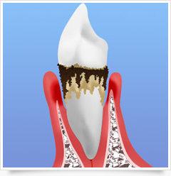 歯ぐきから血がでるなら……歯周病治療